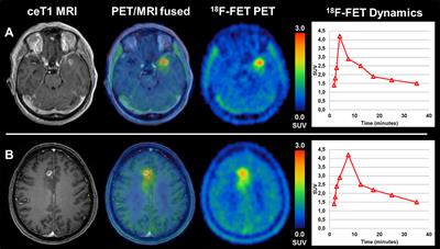 TERT-Promoter Mutational Status in Glioblastoma – Is There an Association With Amino Acid Uptake on Dynamic 18F-FET PET?